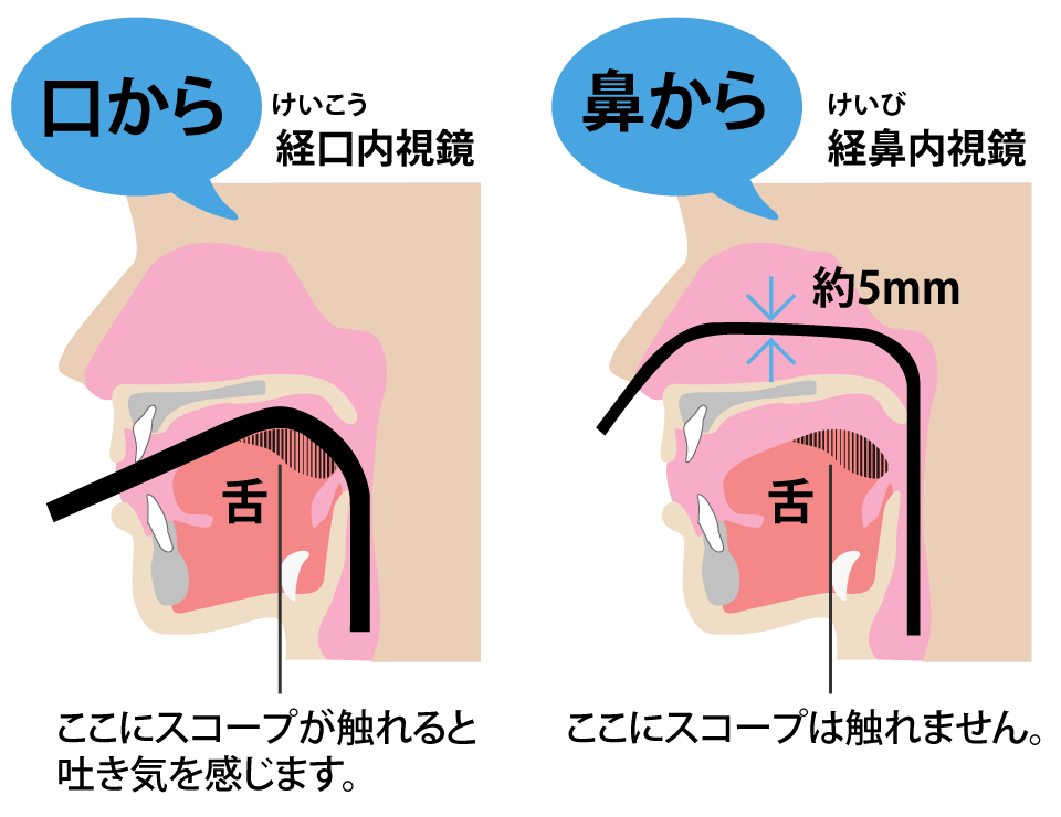 経口内視鏡と経鼻内視鏡の比較